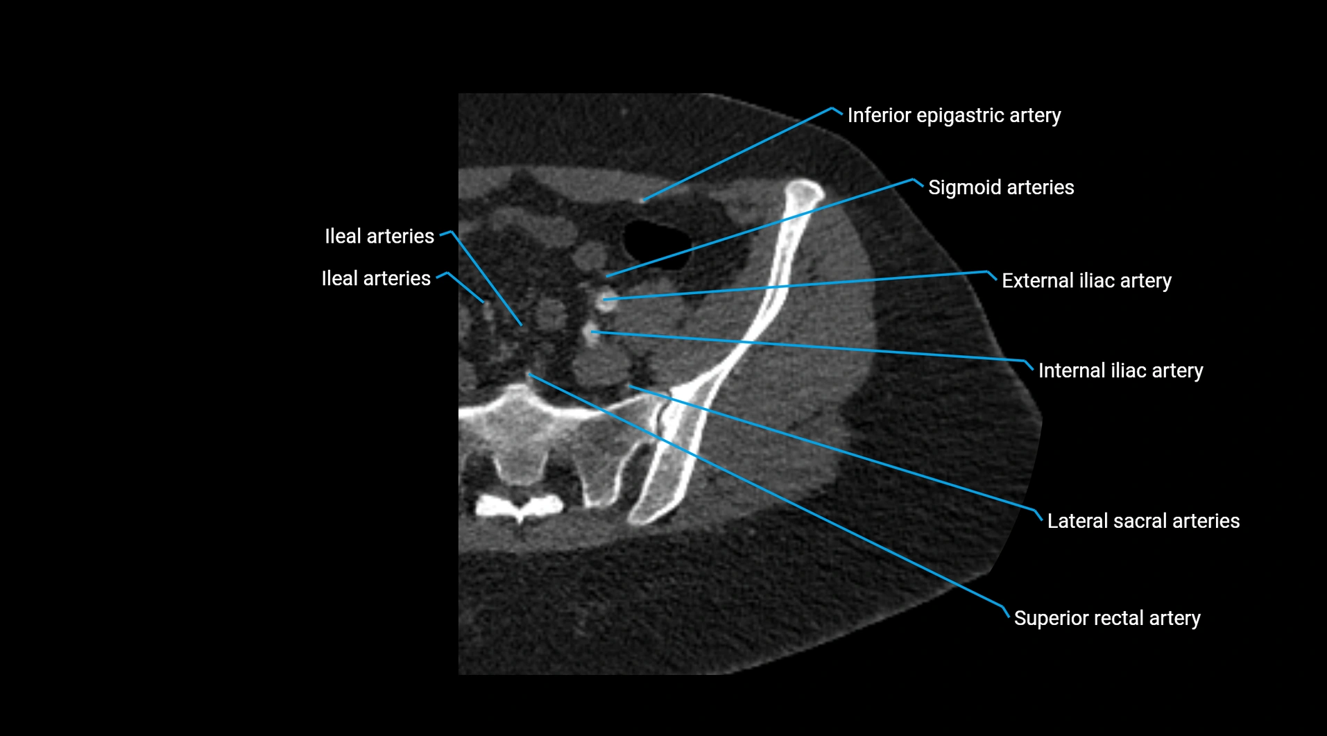 CTA lower limb cross sectional anatomy labelled image _24.webp